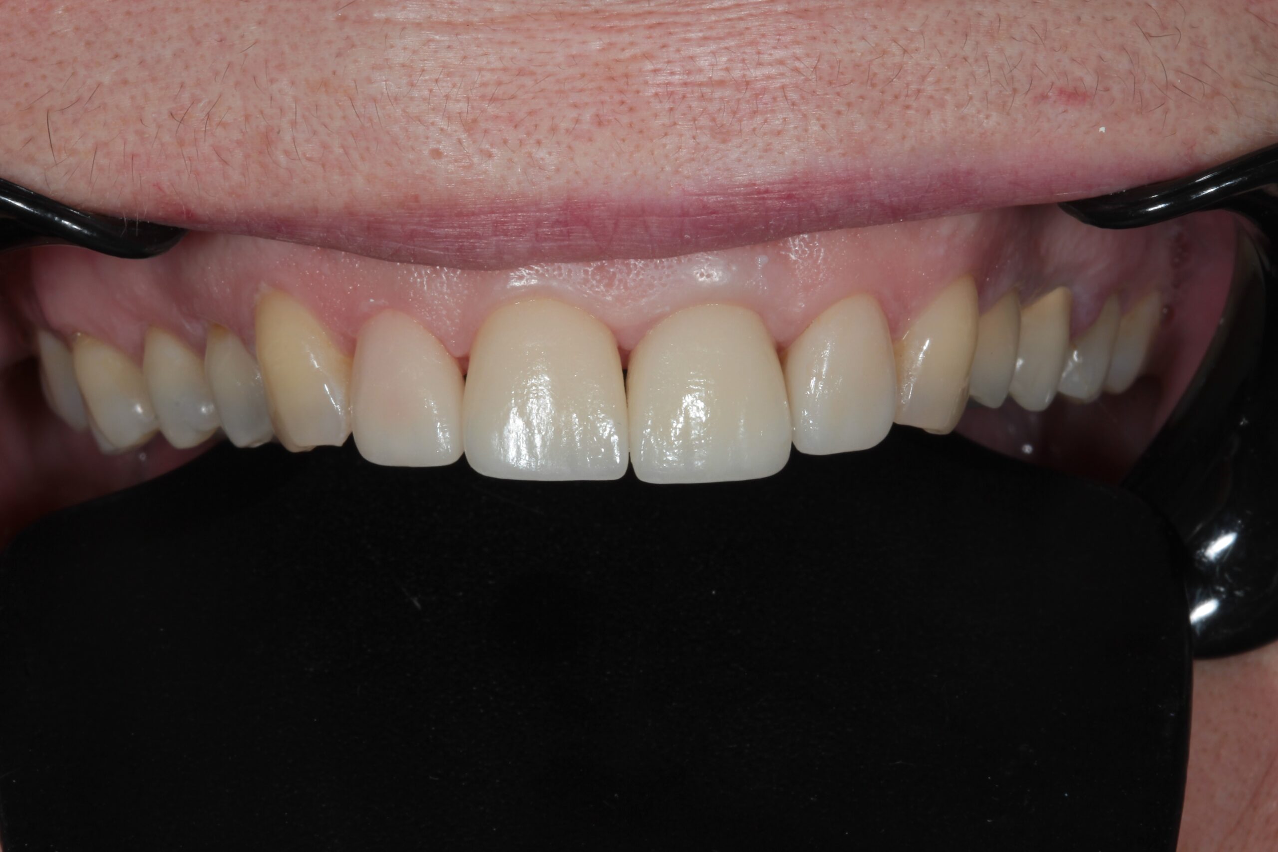 After treatment