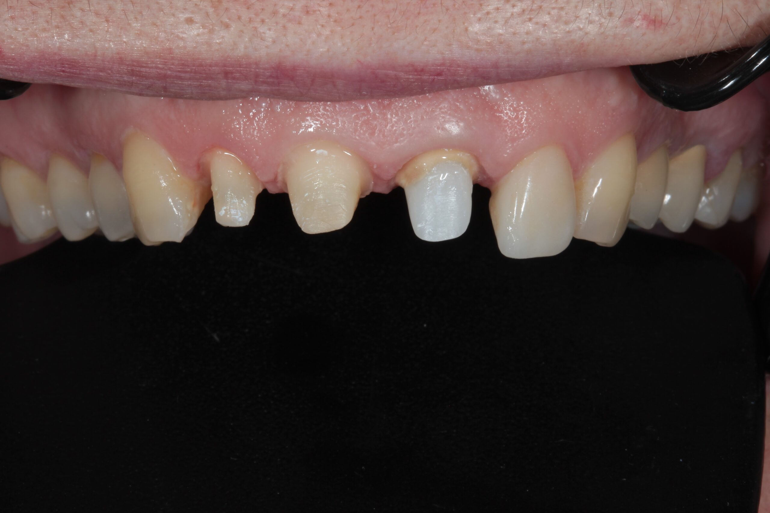 Before treatment
