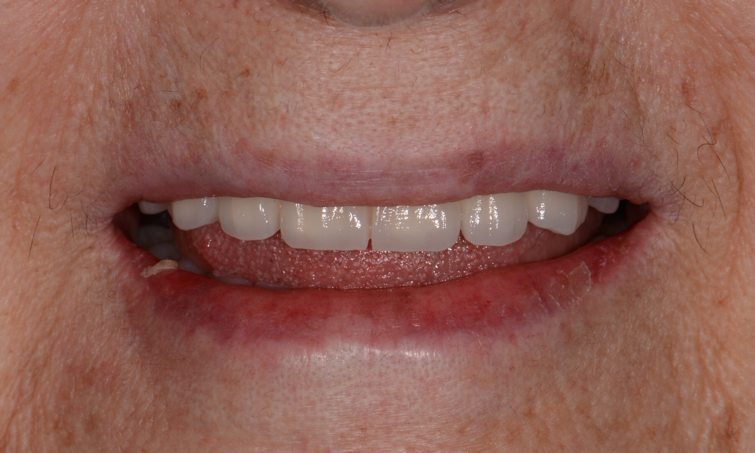 After treatment