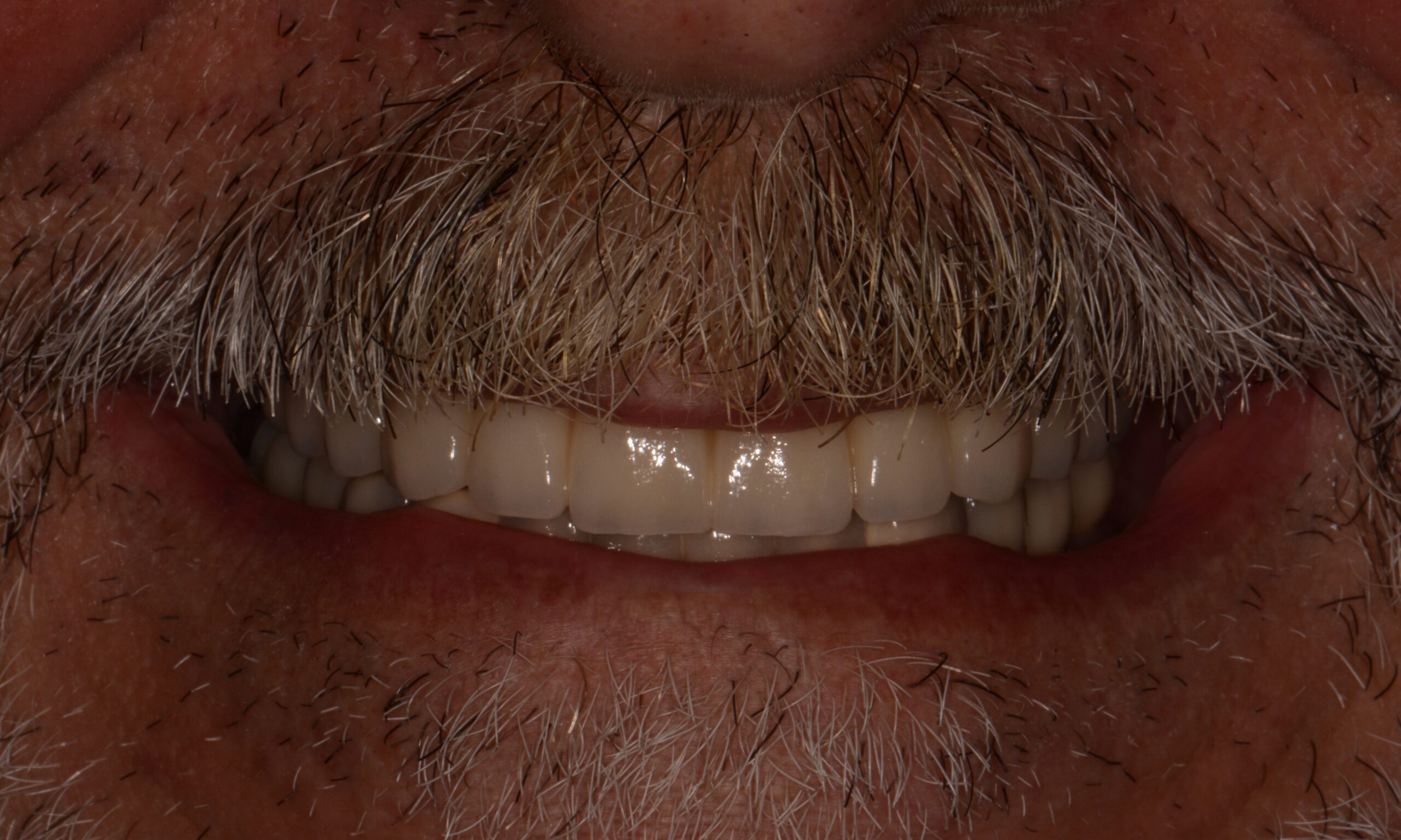 After treatment