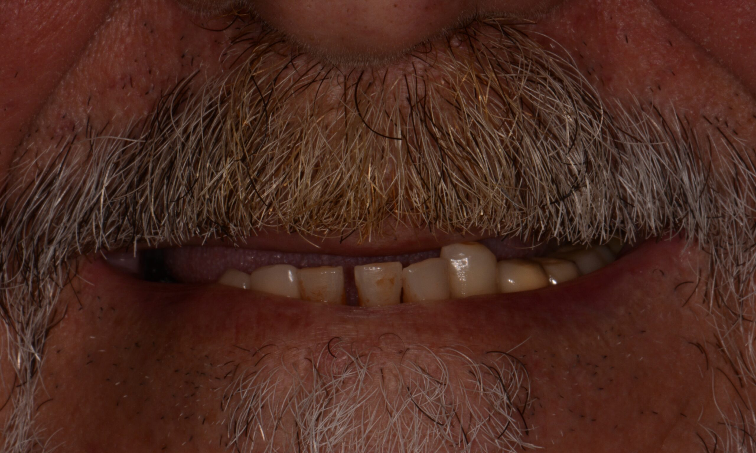 Before treatment