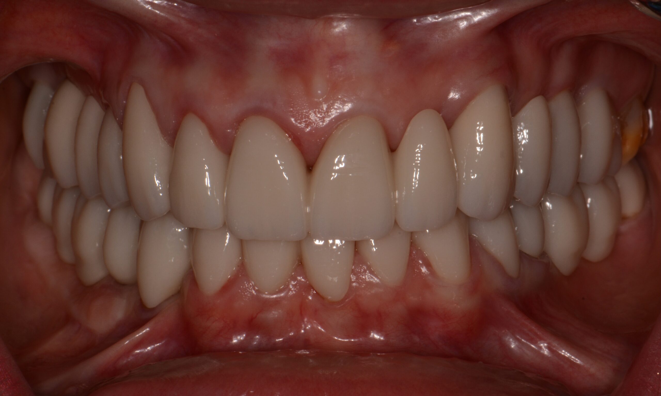 After treatment