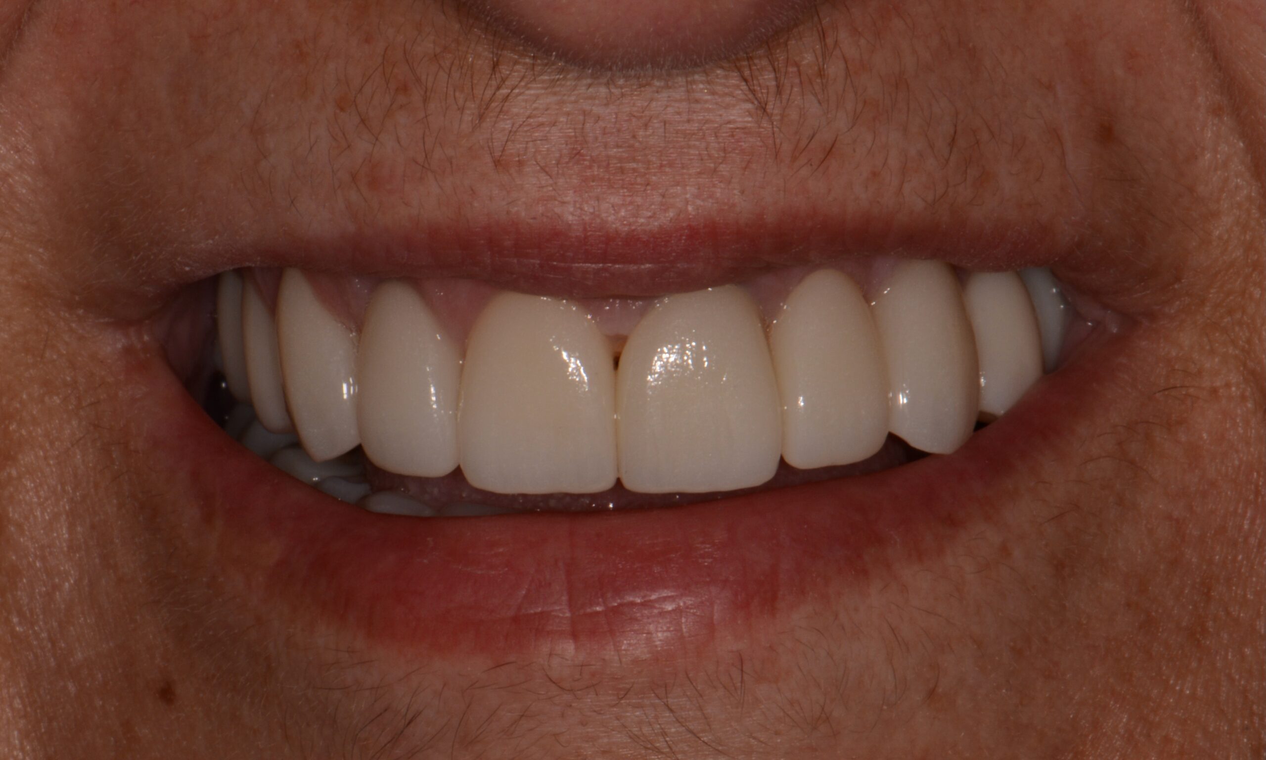 After treatment
