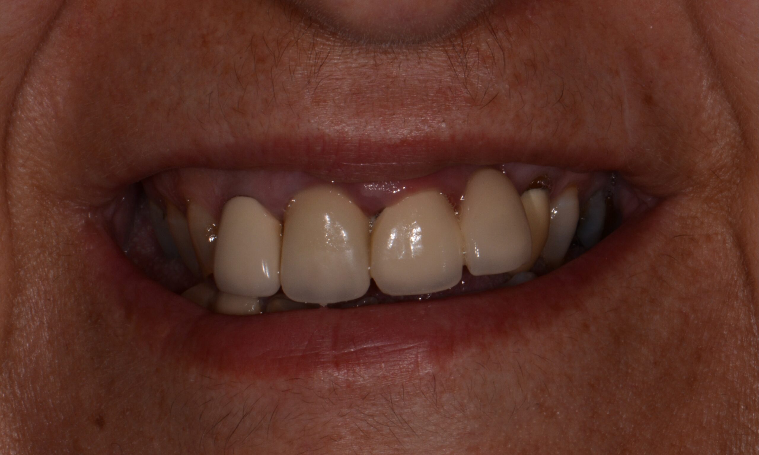 Before treatment