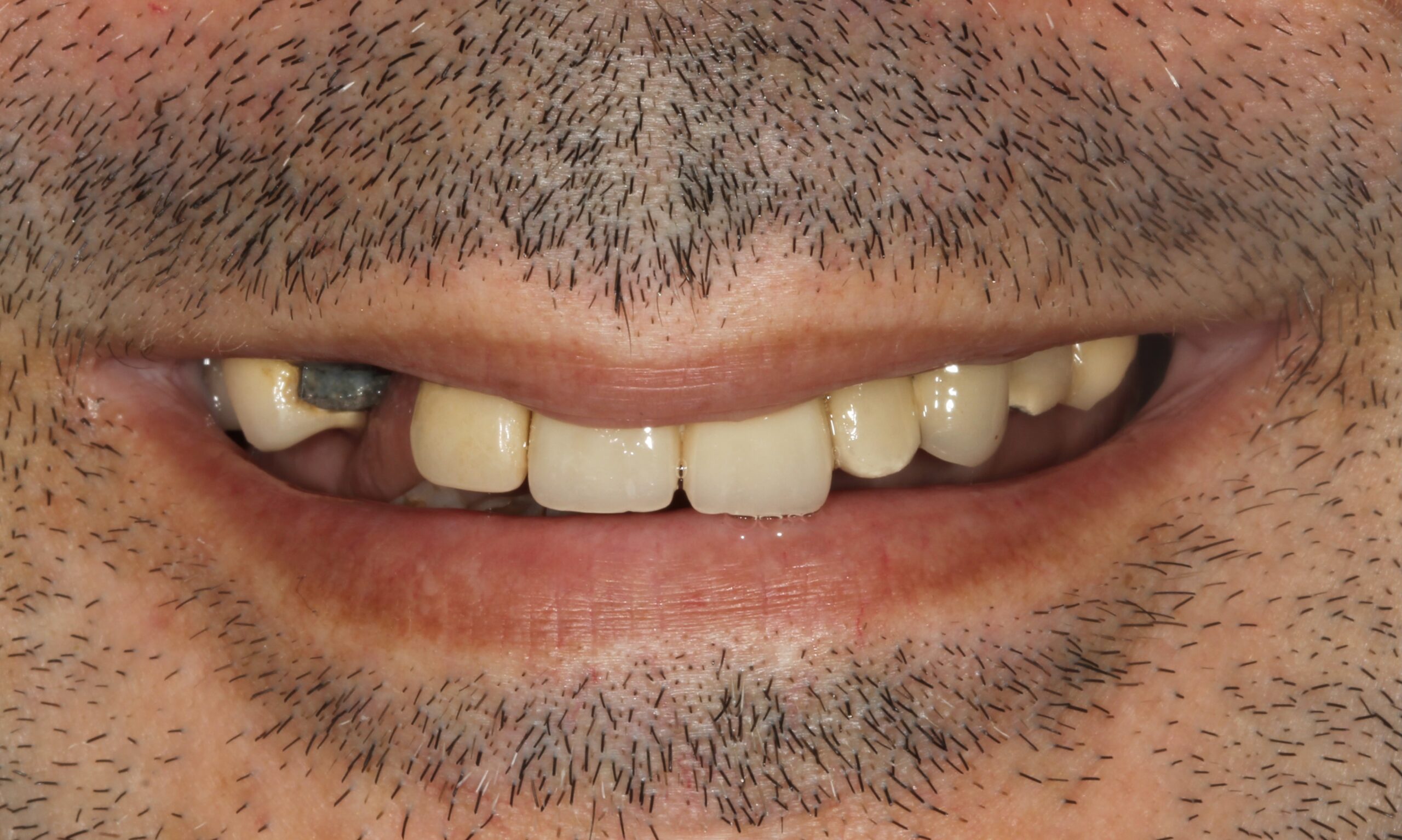 Before treatment