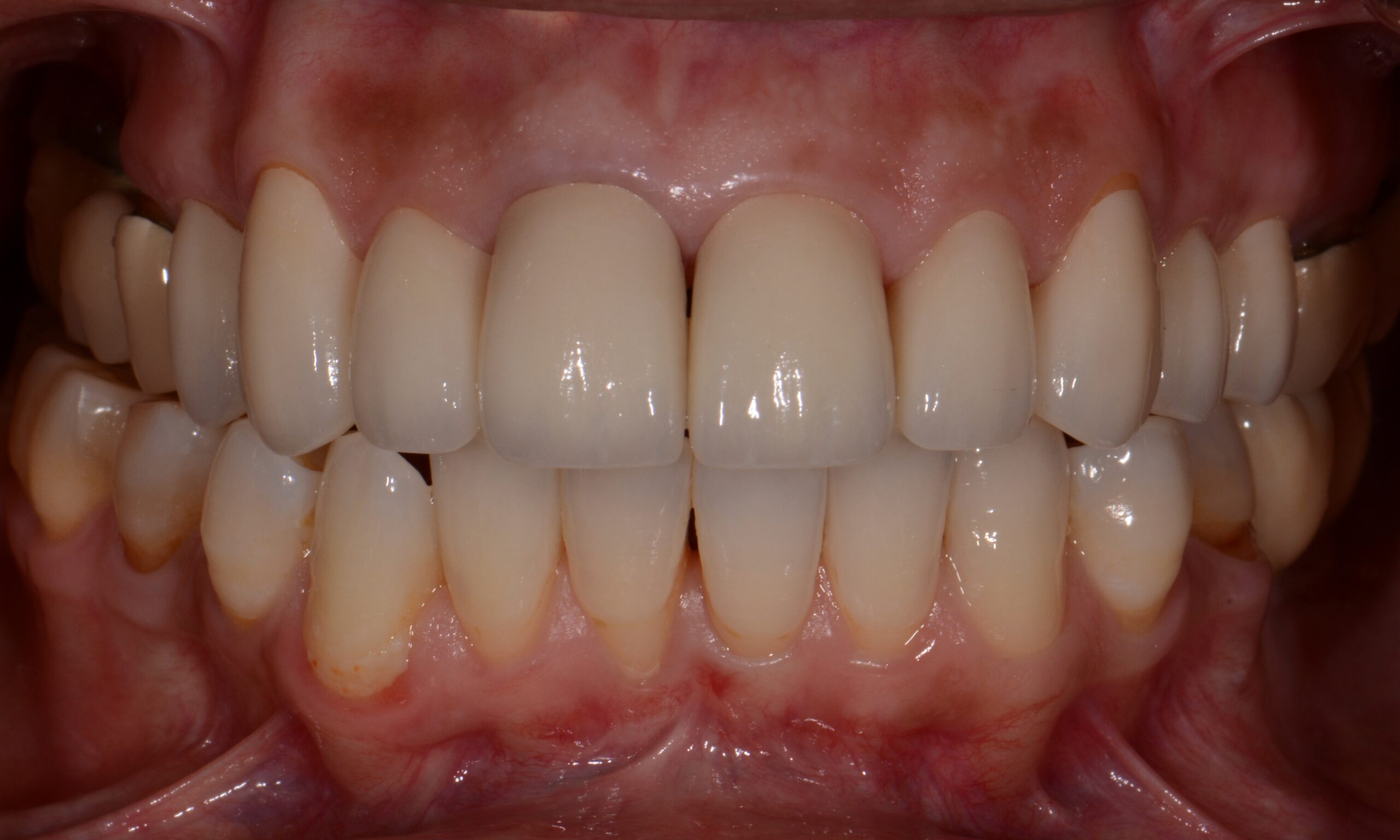 After treatment