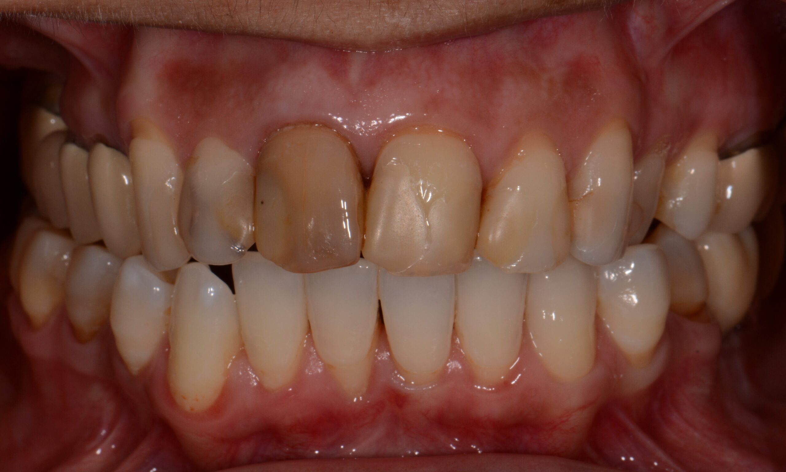 Before treatment