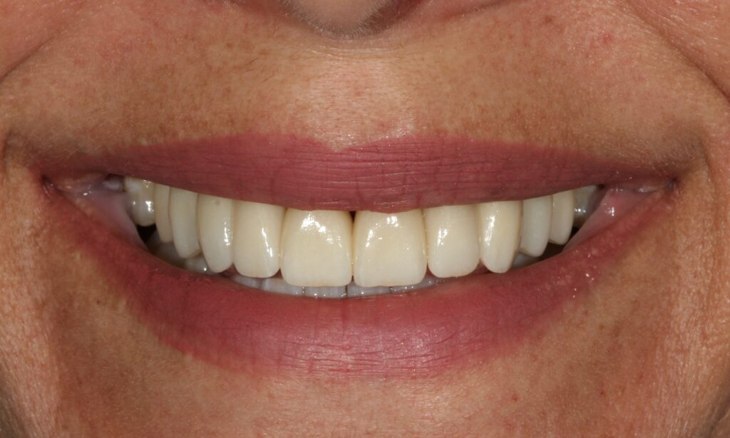 R.A.C.4.After