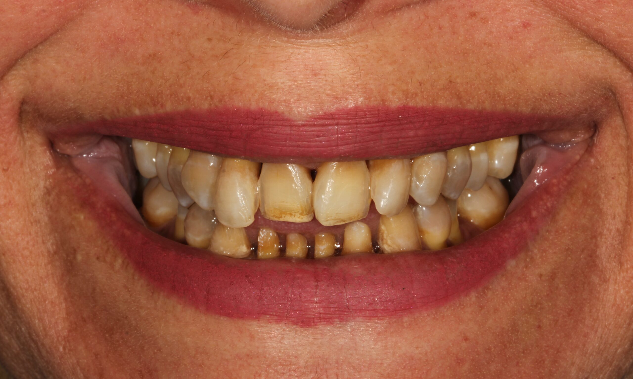 Before treatment