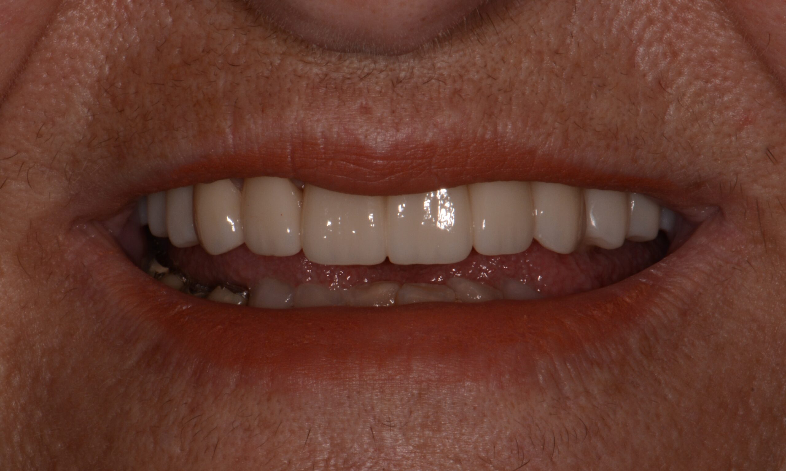After treatment