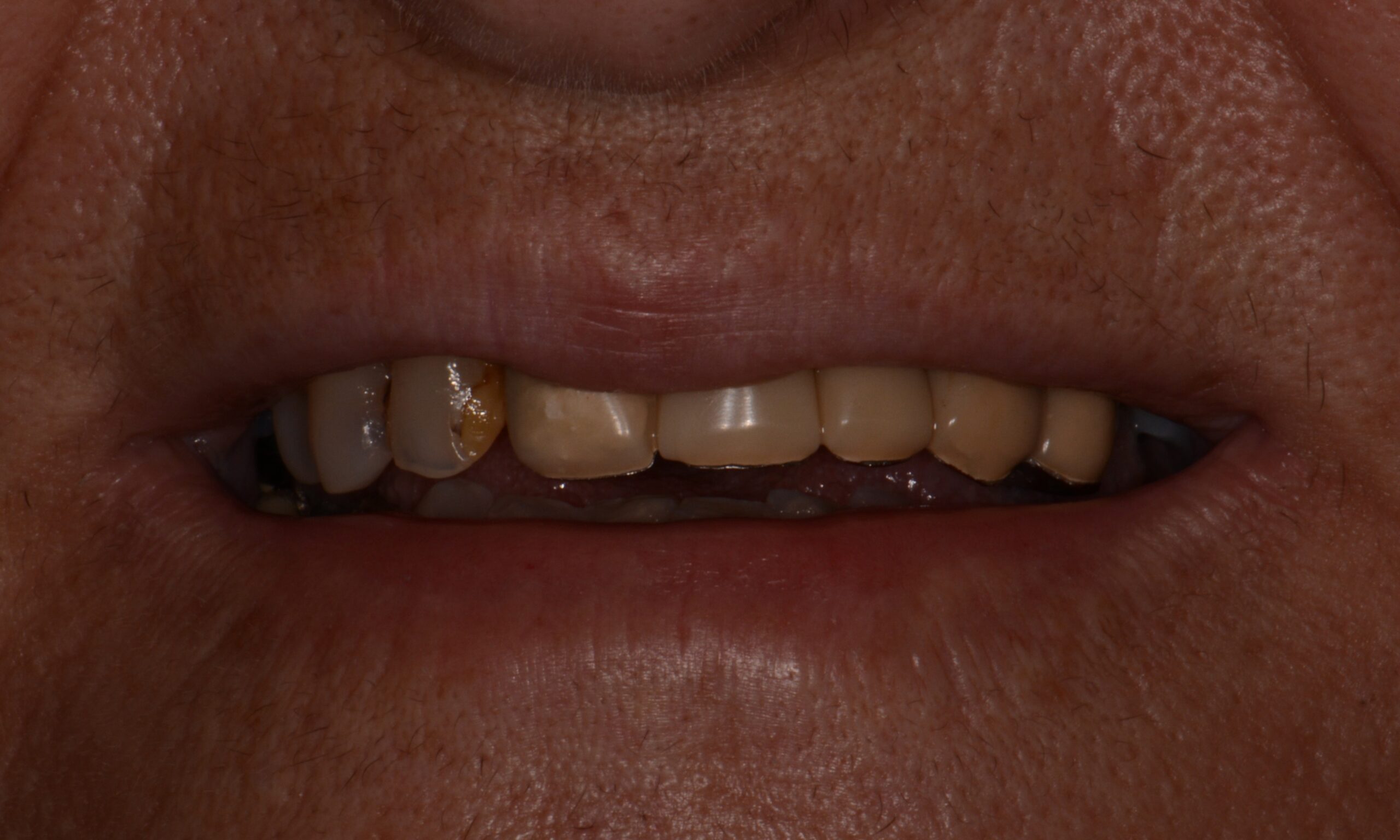 Before treatment