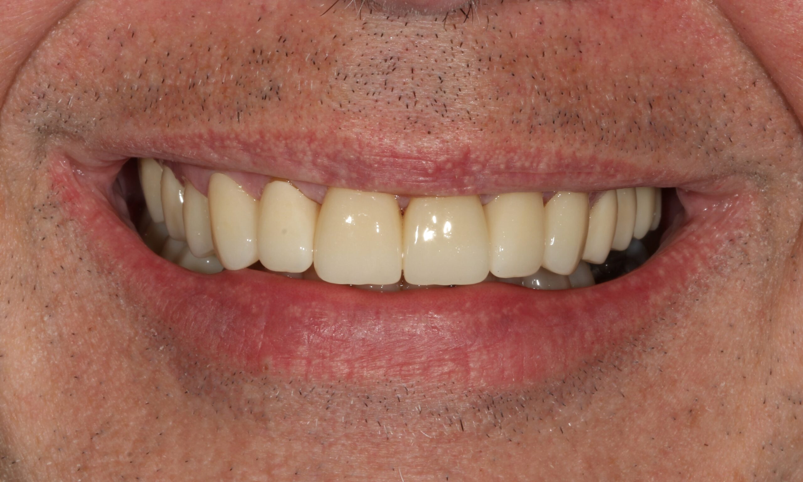 After treatment