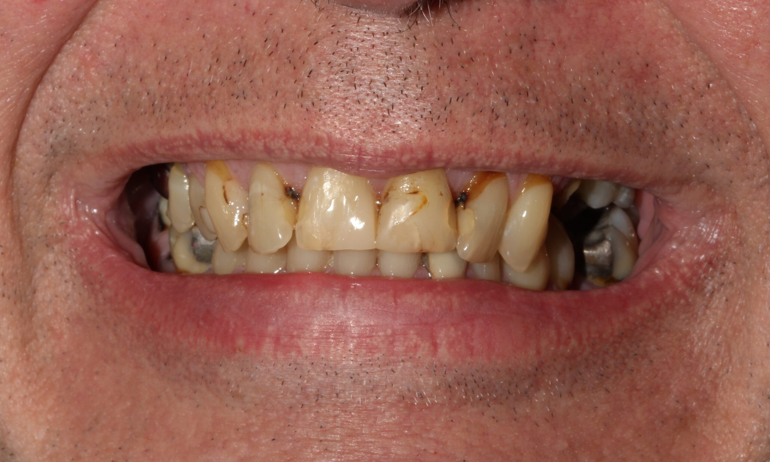 Before treatment