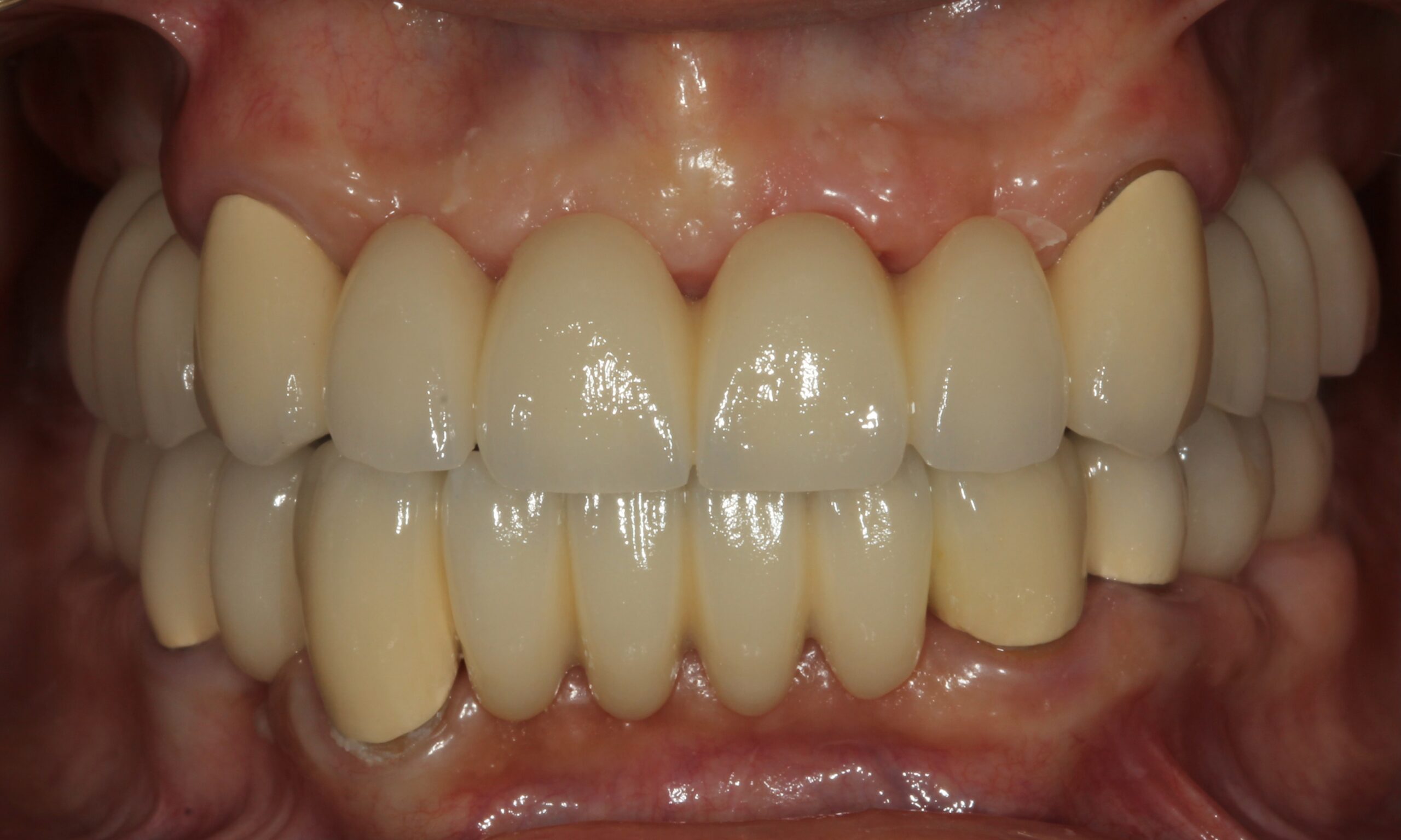 After treatment