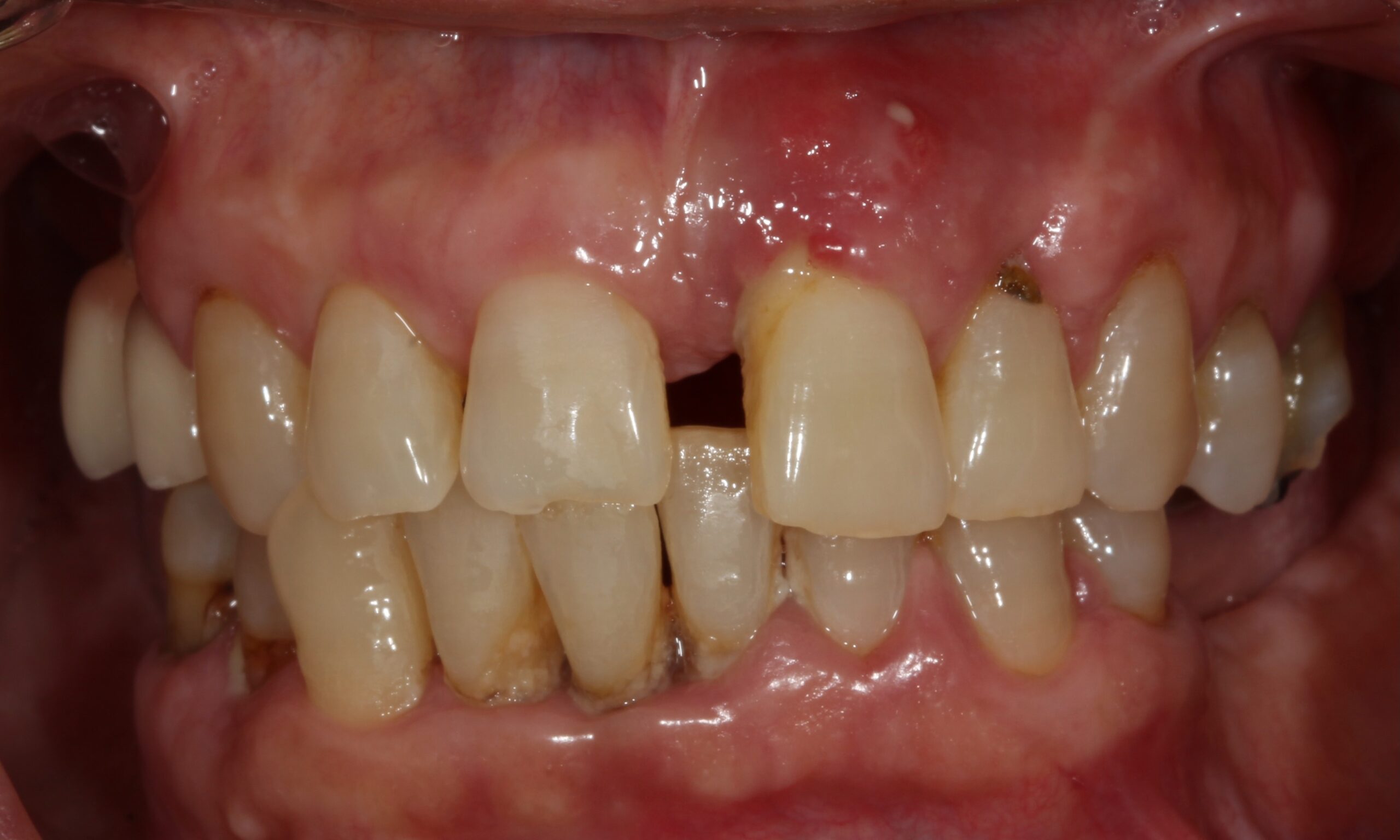 Before treatment