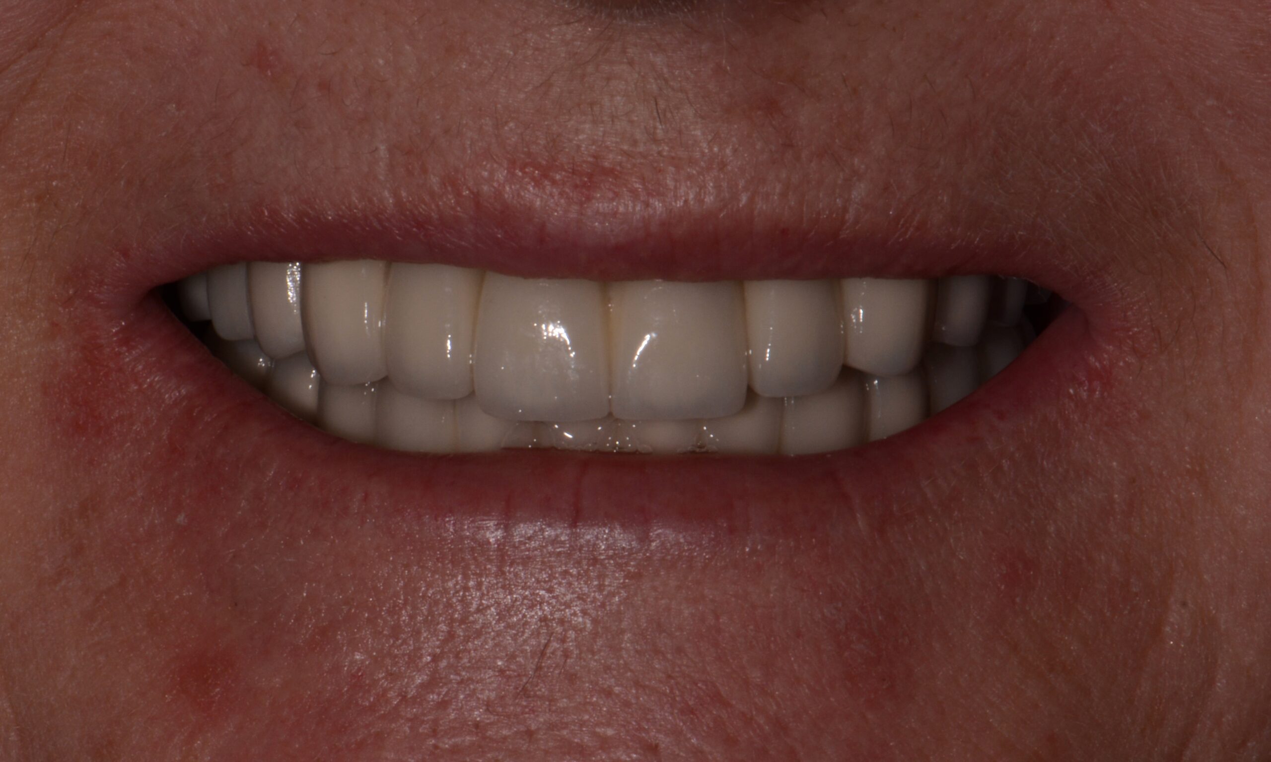 After treatment