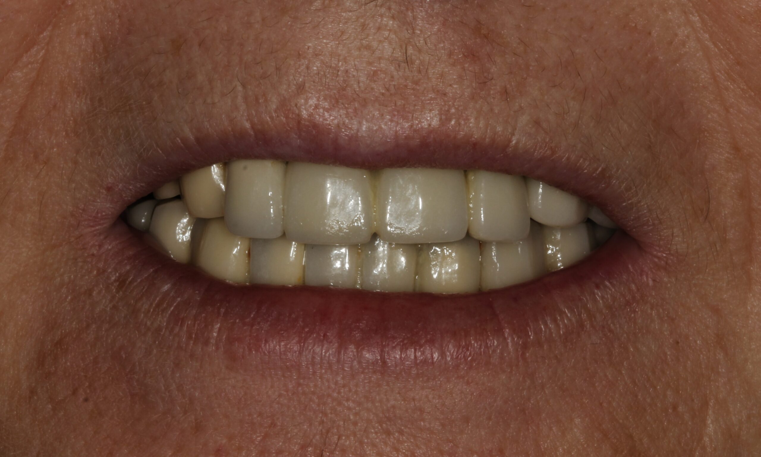Before treatment
