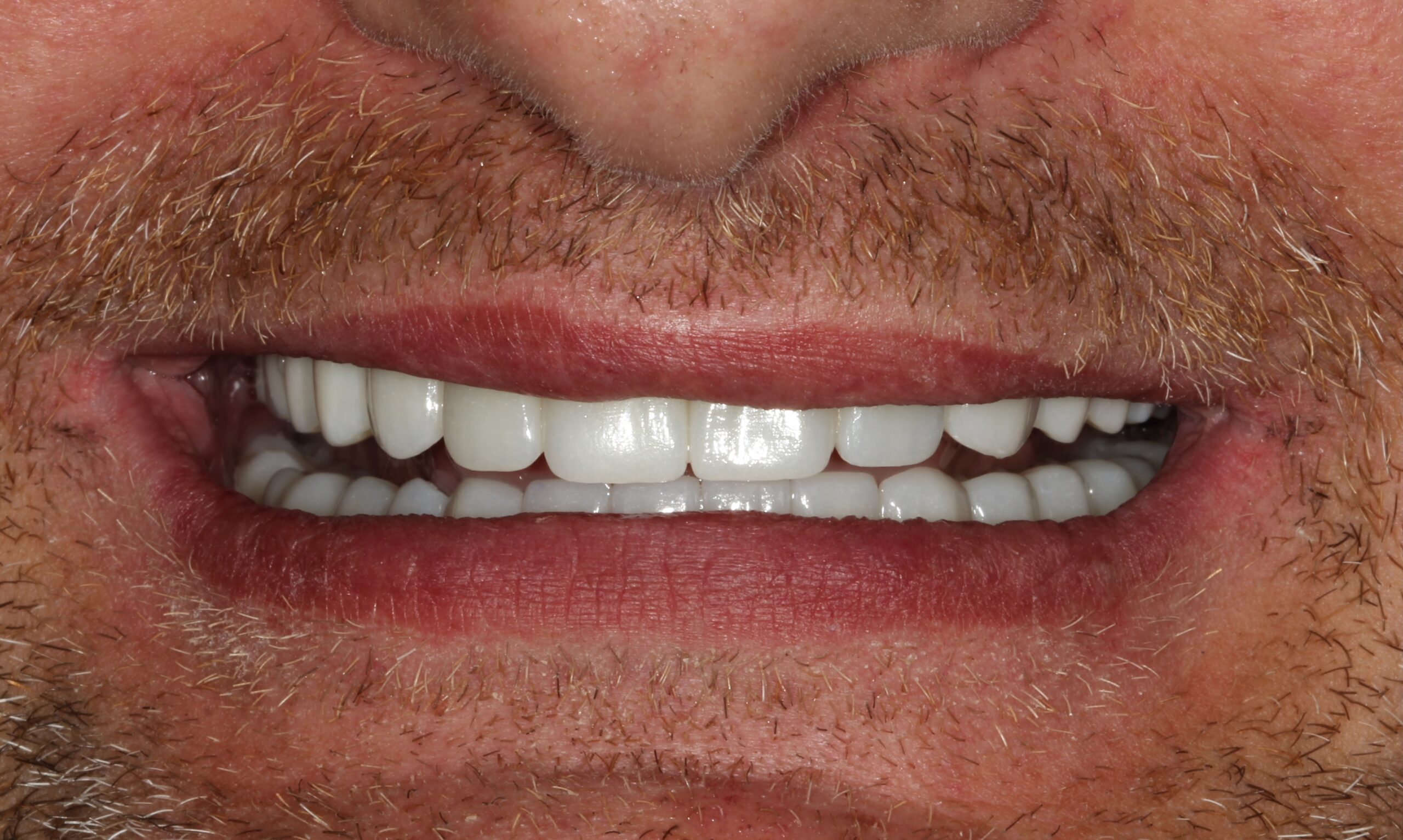 After treatment