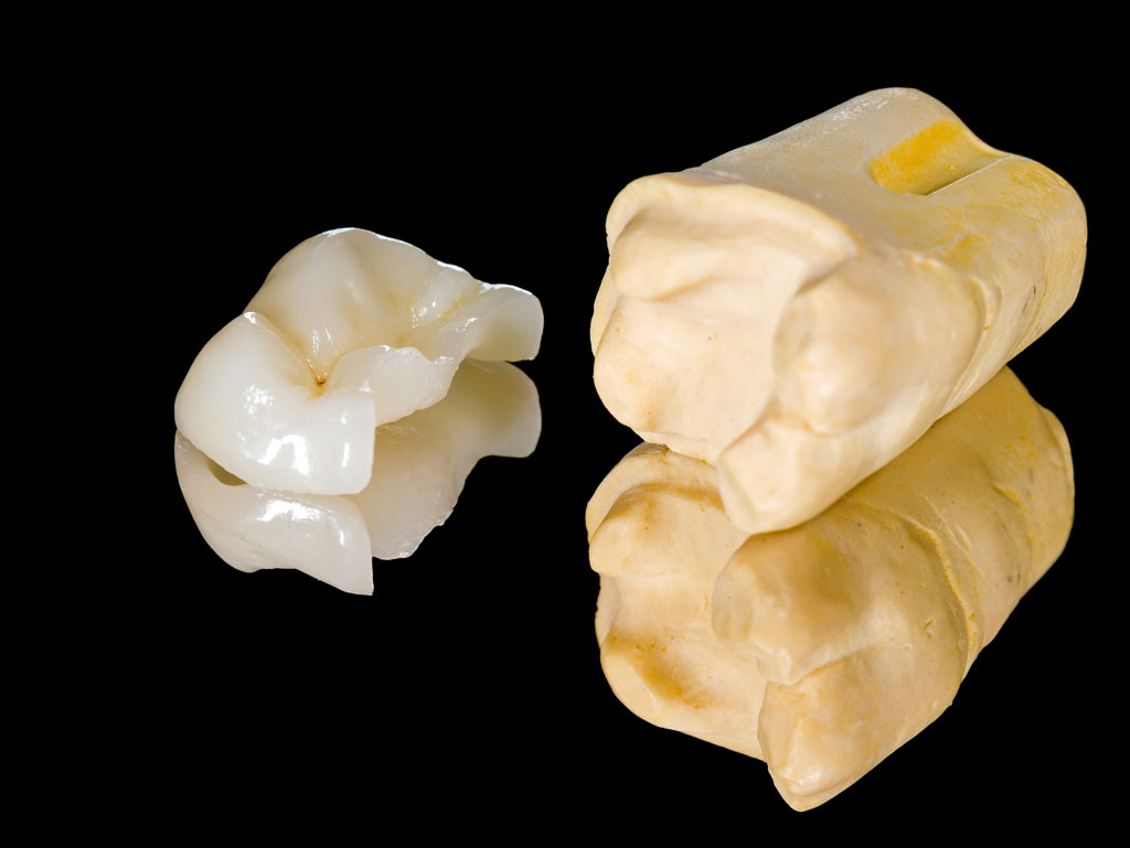Inlays-and-onlays