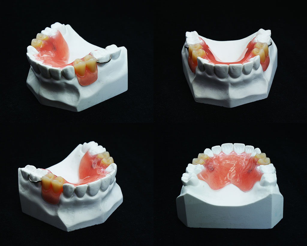 acrylic-full-dentures-2