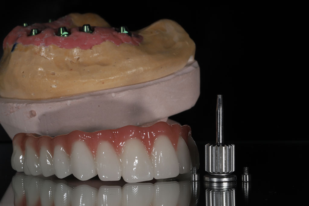 dental-impants-2