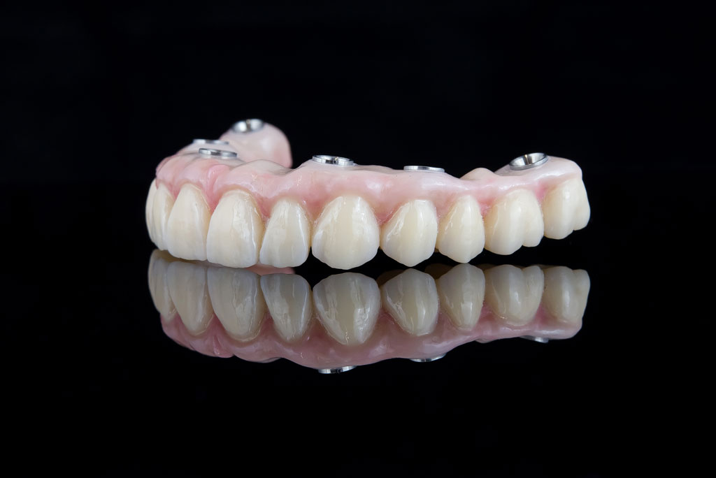 dentl-implants-1