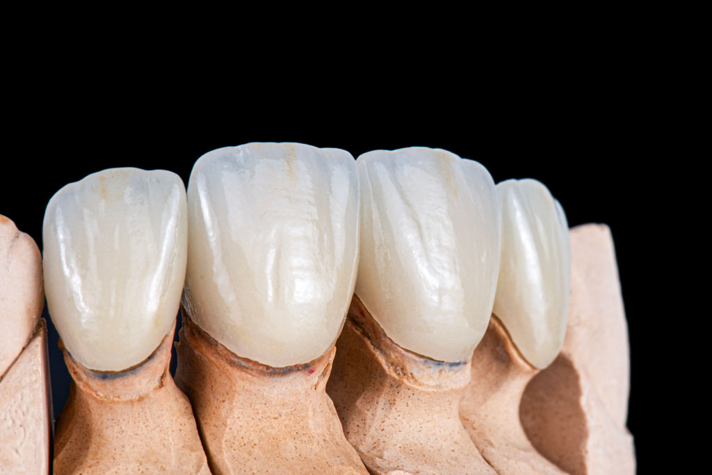 full-ceramic-2