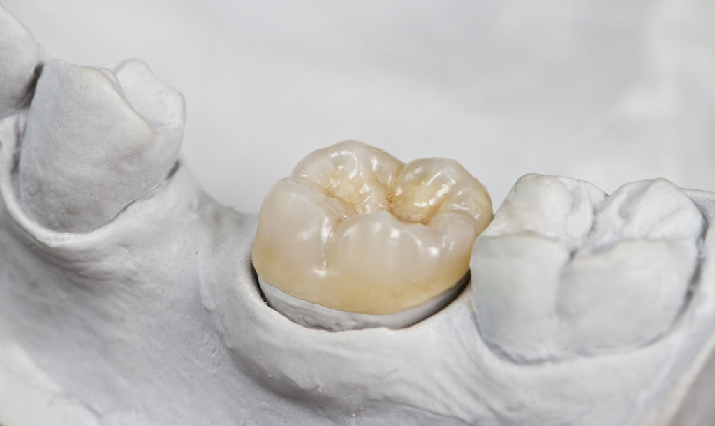inlays-and-onlays-3